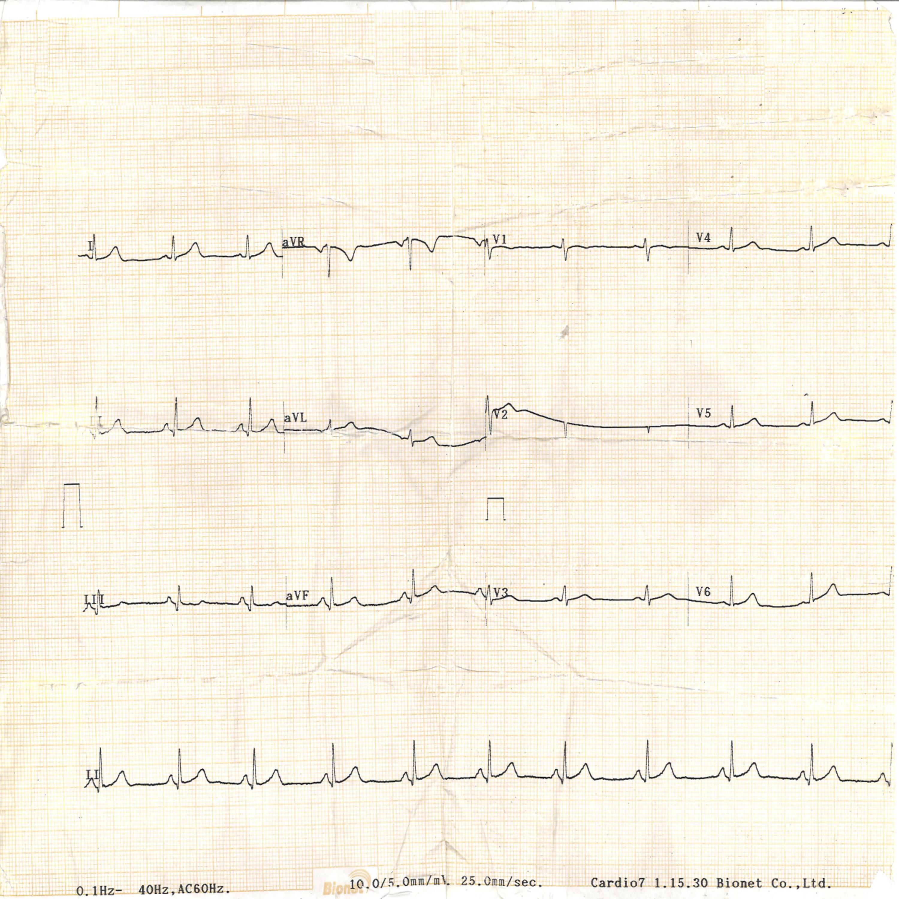 Heart Rate