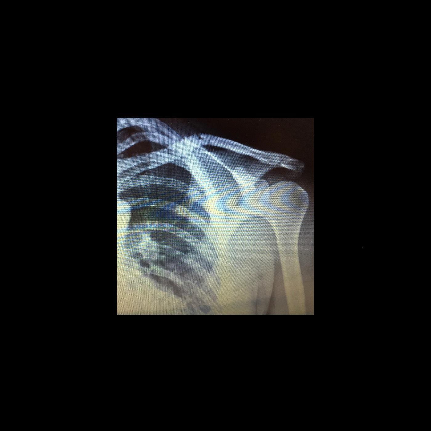 Left Clavicle